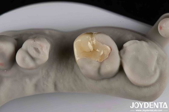 Résistance aux fractures Emax Inlay Onlay Esthétique naturelle et durabilité