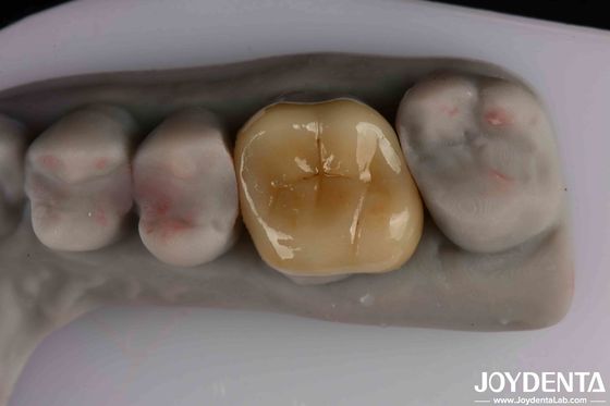Facile à nettoyer et durable Emax Inlay Onlay Résistance à la coloration pour des performances optimales