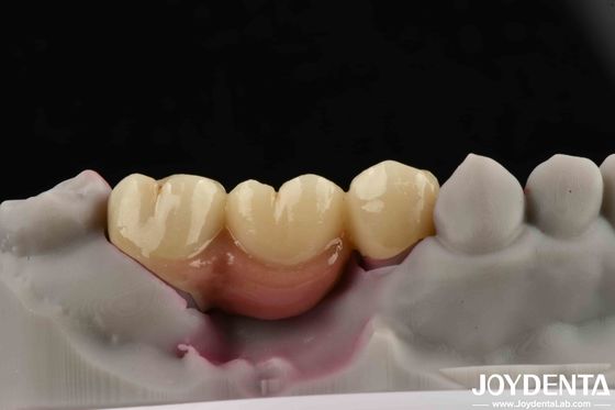 Ponte et couronne pour implants dentaires personnalisables