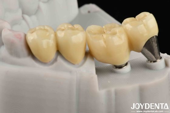 Une couronne d'implant et un pont d'implant naturels sont sûrs pour une performance orale durable.