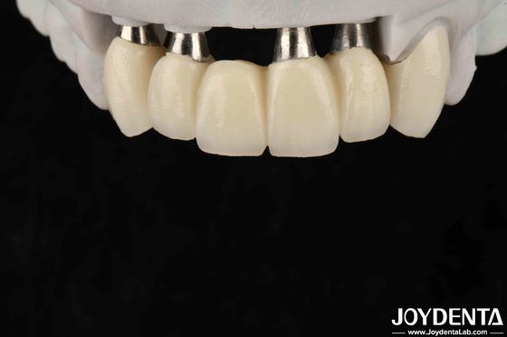Couronne et pont d'implant personnalisables pour une biocompatibilité orale sûre
