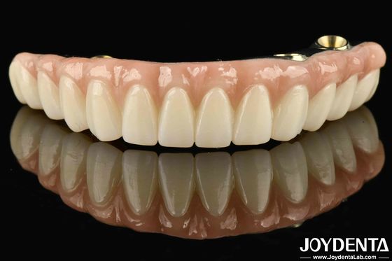Pont hybride en zirconium en Ti-Bar compatible avec les dents et les gencives naturelles Autobiographie Restauration de la fonction de mâcher