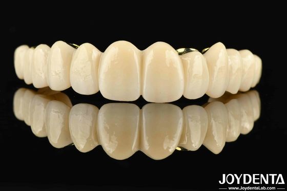 Un pont hybride en zirconium en Ti-Bar fait sur mesure, une combinaison parfaite de confort et de fonctionnalité.