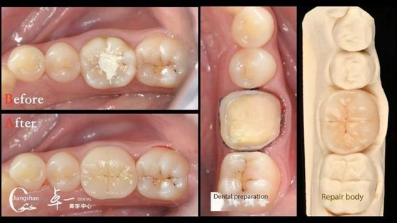 Biocompatibilité et haute compatibilité avec les dents naturelles