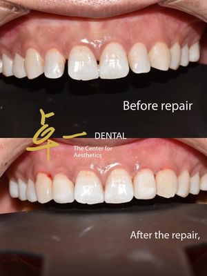 Dites bonjour à un sourire impeccable avec des facettes dentaires cosmétiques sans décoloration ni préparation