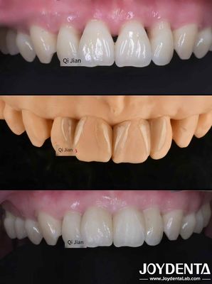 Les facettes de sauterelle sont la solution parfaite pour les facettes dentaires translucides naturelles