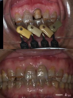 Translucides couronnes en zirconium technologie de dégradation multicouches pour une translucide optimale et une biocompatibilité à long terme