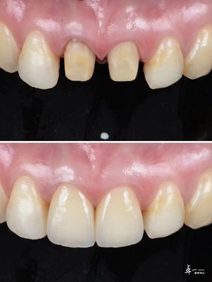 Les facettes sont fabriquées avec du zirconium dentaire résistant à la fracture et une technologie de dégradation multicouche