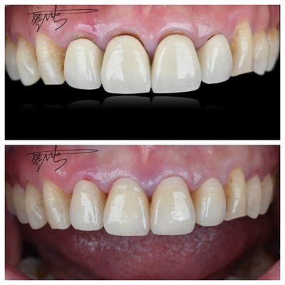 Des ponts dentaires en zirconium confortables, légers, des transitions de couleur naturelles pour une expérience optimale du patient