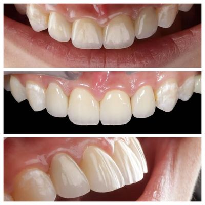 Indication des dents antérieures Faisceaux dentaires d'épaisseur de 0,5 mm et parfaite perméabilité
