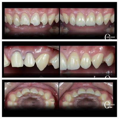 Les facettes dentaires naturelles pour un sourire naturel et beau