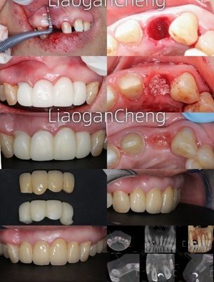 Technologie de dégradation multicouche Zirconia dentaire sûre et esthétique à long terme