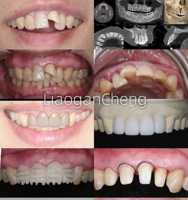 Biocompatibilité Des couronnes dentaires en zirconium sûres pour les restaurations à long terme et les implants