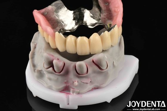Matériau métallique dentaire avancé pour les besoins de mastication
