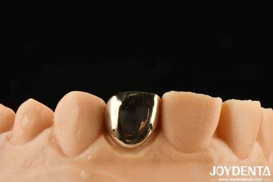 Découvrez la réhabilitation orale comme jamais auparavant avec la coulée de cire de la couronne d'or
