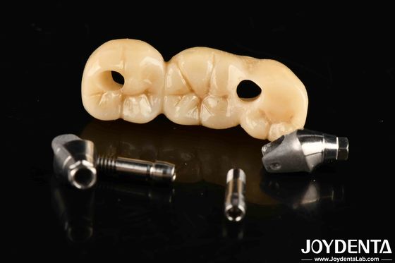 Implantation couronne et pont avec conception personnalisable haute durabilité ajustement précis