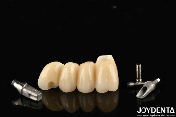 Couronne et pont d'implant personnalisables en porcelaine pour une fonction parfaite