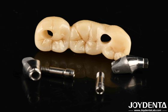 Une couronne et un pont d'implant sont une solution parfaite pour une esthétique esthétique.