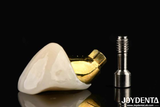 Couronne et pont d'implant de longue durée pour restaurer les dents manquantes