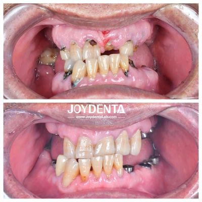 Résistant à l'usure et à la déformation Couronnes dentaires en zirconium Durables et adaptées aux restaurations postérieures et antérieures