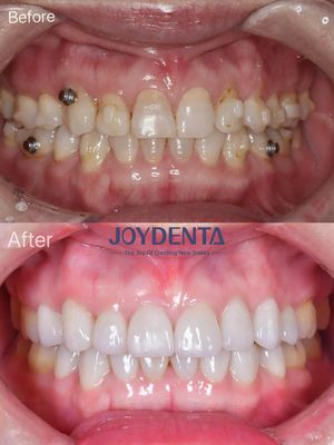Restauration orale par placage en porcelaine