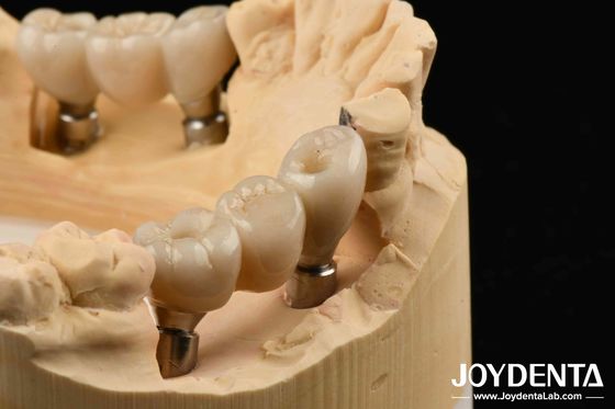 Implants en zircone : une parfaite harmonie avec les dents naturelles et aucun risque d'allergie