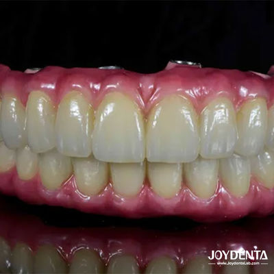 Un pont hybride en titane dentaire léger et confortable pour la restauration dentaire