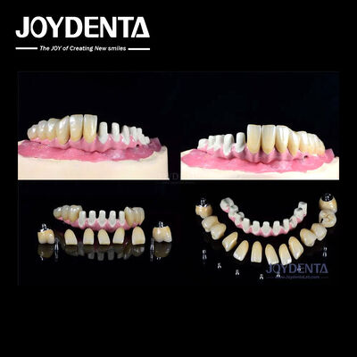 Implants dentaires endosseux multiples Connexion interne pour la restauration complète de l'arc