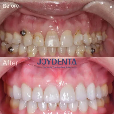 Les placages dentaires pour les dents manquantes.