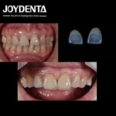 0Épaisseur de.5 mm Faisceaux dentaires en céramique naturels à la recherche d'indications sur les dents antérieures