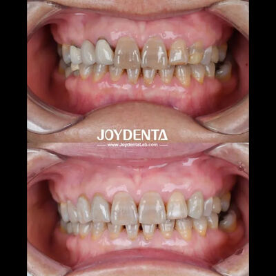 Zircone dentaire léger pour une expérience patient optimale Couleur naturelle