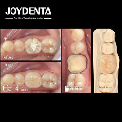 Biocompatibilité et haute compatibilité avec la restauration des dents naturelles