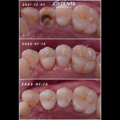 Incrustation de porcelaine dentaire de bon ajustement pour la restauration des dents endommagées